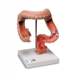 Darmziektes Model