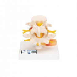 Lumbale Wervelkolom met Verzakte Tussenwervelschijf