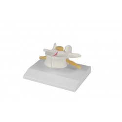 Wervel Model met Osteoporose, 2 x ware grootte