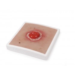 Colostoma met Ontsteking Model Colostoma met Ontsteking Model
