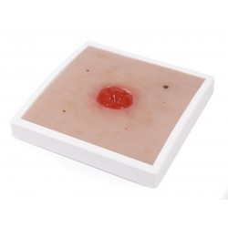Colostoma onder huidniveau Model Colostoma onder huidniveau Model
