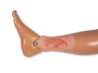 Arteriële Beenzweer Wond, Epithelisatiefase