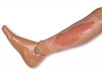 Arteriële Beenzweer Wond, Epithelisatiefase