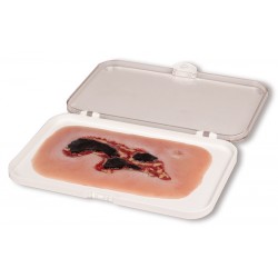 Arteriële Beenzweer Wond, Exsudatiefase Arteriële Beenzweer Wond, Exsudatiefase