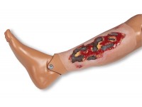 Arteriële Beenzweer Wond, Exsudatiefase
