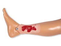 Arteriële Beenzweer Wond, Granulatiefase Arteriële Beenzweer Wond, Granulatiefase