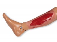 Arteriële Beenzweer Wond, Granulatiefase Arteriële Beenzweer Wond, Granulatiefase