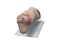 Oefenmodel Veneuze Insufficiëntie Oefenmodel Veneuze Insufficiëntie