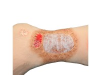 Oefenmodel Veneuze Insufficiëntie Oefenmodel Veneuze Insufficiëntie