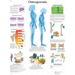 Osteoporosis, gelamineerde wandplaat