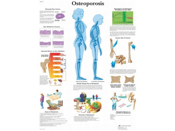 Osteoporosis, gelamineerde wandplaat