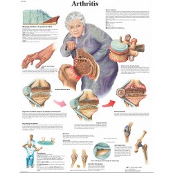 Arthritis, gelamineerde wandplaat