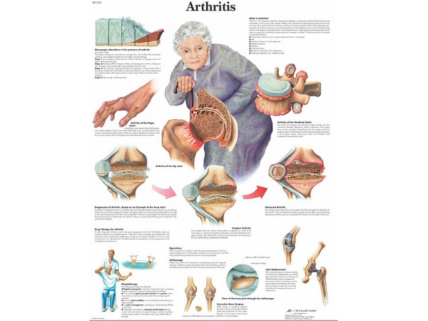 Arthritis, papieren wandplaat