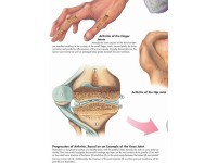 Arthritis, papieren wandplaat