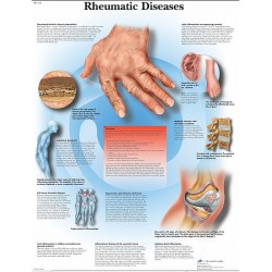 Reuma, gelamineerde wandplaat