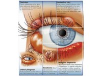 Anatomie Poster Ziektebeelden van het Oog, papier