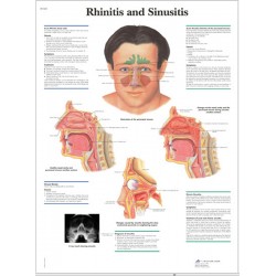 Rhinitis & Sinusitis, papieren wandplaat Rhinitis & Sinusitis, papieren wandplaat