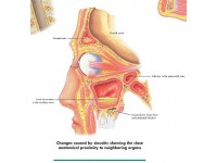Rhinitis & Sinusitis, papieren wandplaat