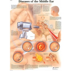 Ziektebeelden van het Middenoor, gelamineerde wandplaat Ziektebeelden van het Middenoor, gelamineerde wandplaat