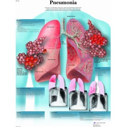 Longontsteking, gelamineerde wandplaat