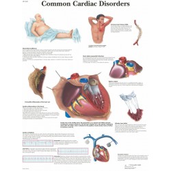 Anatomie Poster Hartziektes, papier Anatomie Poster Hartziektes, papier