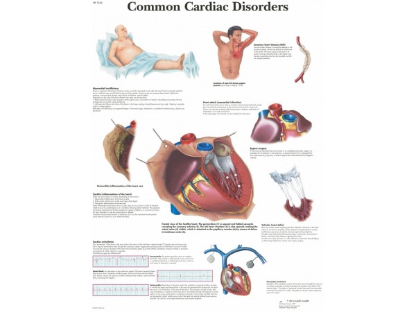 Anatomie Poster Hartziektes, gelamineerd
