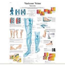 Anatomie Poster Varicose Veins (spat-aderen), papier Anatomie Poster Varicose Veins (spat-aderen), papier