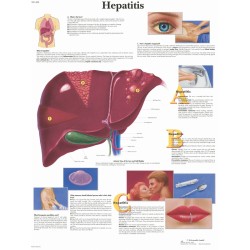Hepatitis, gelamineerde wandplaat