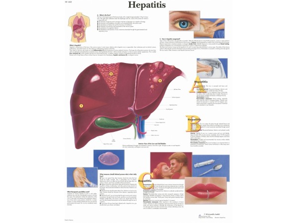 Hepatitis, gelamineerde wandplaat