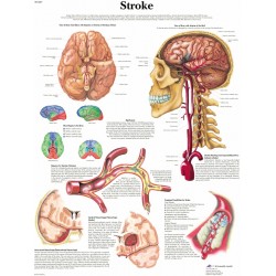 Anatomie Poster Hersenbloeding, papier Anatomie Poster Hersenbloeding, papier