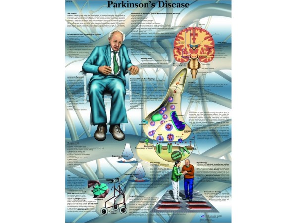 Parkinson, gelamineerde wandplaat
