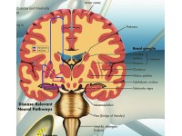 Parkinson, gelamineerde wandplaat