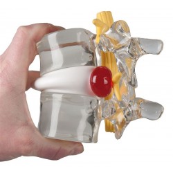 Demonstratie Lumbale Hernia, 2x ware grootte Demonstratie Lumbale Hernia, 2x ware grootte