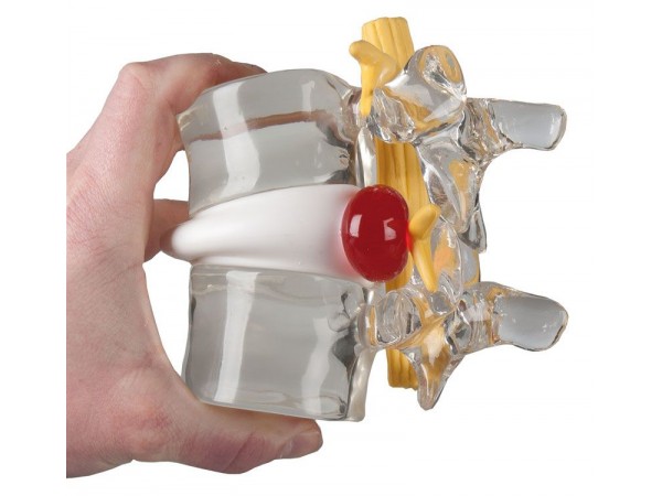 Demonstratie Lumbale Hernia, 2x ware grootte
