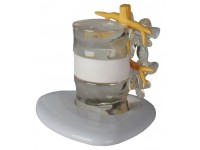 Demonstratie Lumbale Hernia, 2x ware grootte