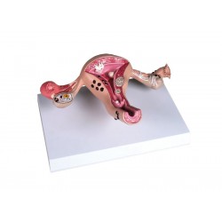 Baarmoeder met ziektebeelden