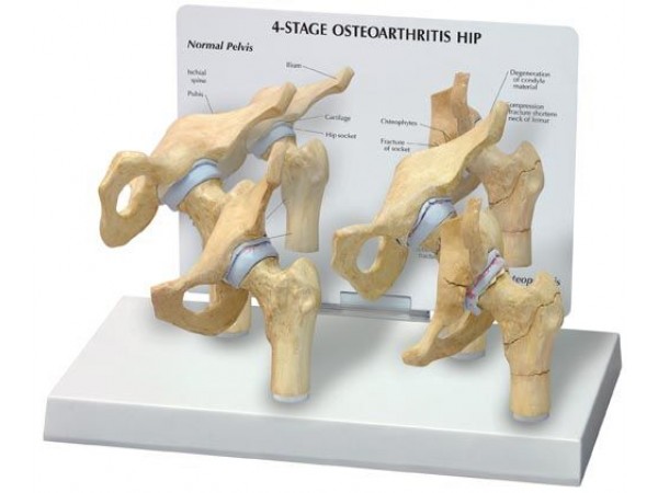 4-stadia Heup met artritis