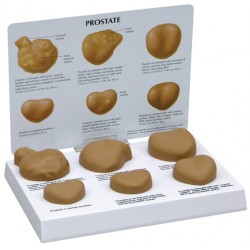 Prostaat Model met Ziektes