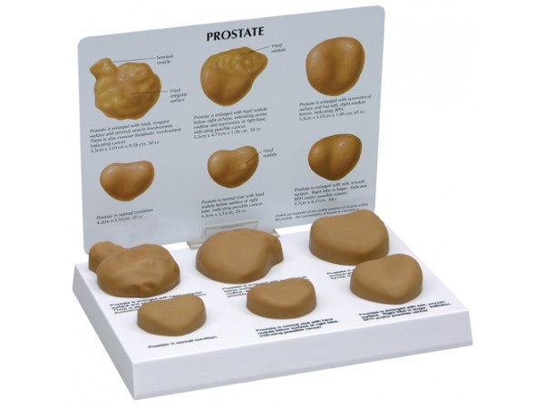 Prostaat Model met Ziektes