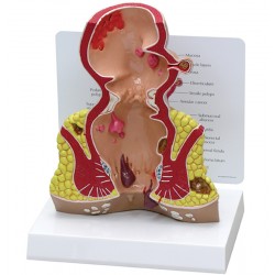 Endeldarm (Rectum), model met infokaart