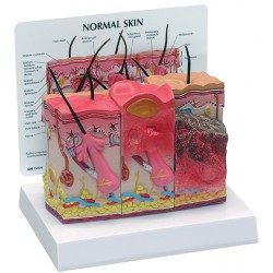 2 zijdig huidmodel: normaal en verbrande huid