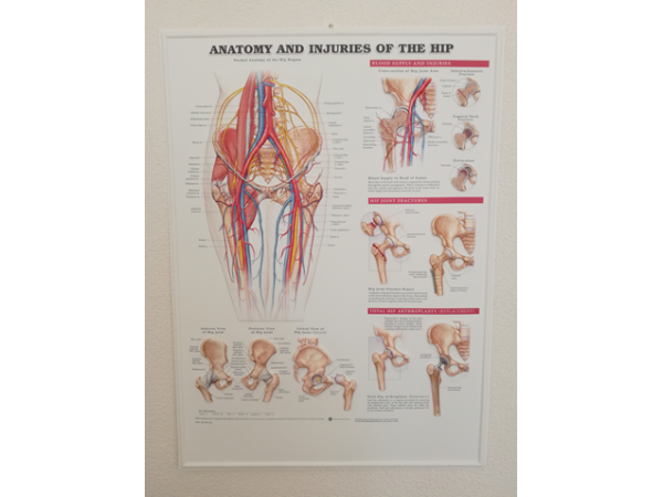 3D Reliëf Poster Anatomie en Blessures van de Heup