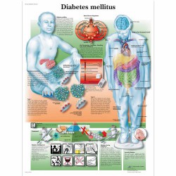 Anatomie Poster Diabetes, gelamineerd