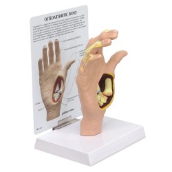 Anatomisch Model Osteoartritis Hand Anatomisch Model Osteoartritis Hand
