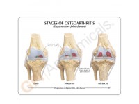 Knie, 4 stadia osteoarthritis