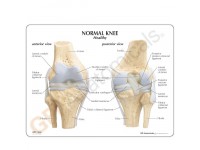 Knie, 4 stadia osteoarthritis