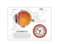 Oogmodel met staar (Cataract)