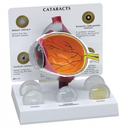 Oogmodel met staar (Cataract) Oogmodel met staar (Cataract)