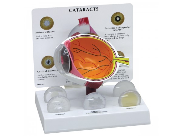 Oogmodel met staar (Cataract)