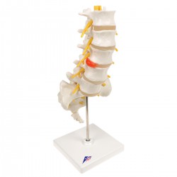 Lumbale Wervelkolom met Hernia